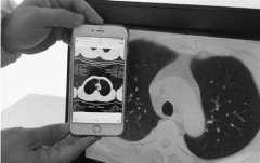 <b>男子8岁开始抽烟44岁长了个80岁的肺</b>