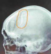 <b>女子大脑藏七厘米长针几十年取出已完全生锈(图)</b>