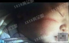 浙江女子剖腹产孩子脸被划伤 院方称产妇肚皮太薄