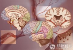 养生：注意这5种典型的中风前兆