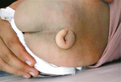 5个月大宝宝长尾巴 妈妈怀孕前期未吃叶酸是祸首