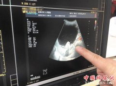 <b>6岁女娃腹胀肚子痛 18厘米卵巢畸胎瘤在作怪</b>