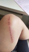 <b>云南女孩报警:她被注射过期的长春长生狂犬病疫苗</b>