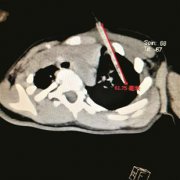 边吃鸡肉串边奔跑　2岁女童肺部被竹签扎穿