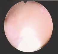 5个月大女婴双肾长满结石 20多个小时无尿 提前喂辅食惹的祸