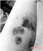 28岁姑娘注射“瘦腿针”，腿部溃烂差点截肢