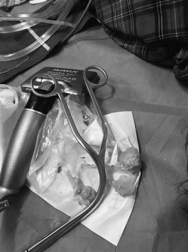 江苏镇江老人突然昏倒 原是被一枚咸蛋黄堵住气道